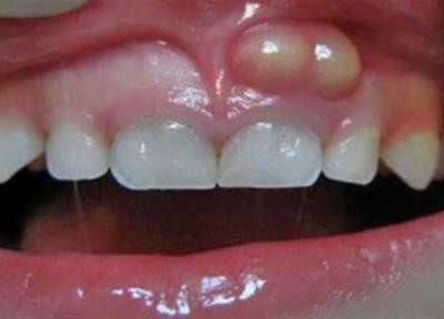 راجع به آبسه دندان چه میدانید؟
